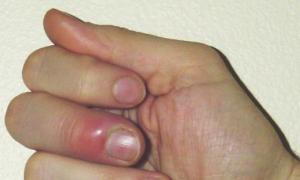 Bolni prsti na rukama i nogama: šta učiniti, kako liječiti apsces kod djeteta